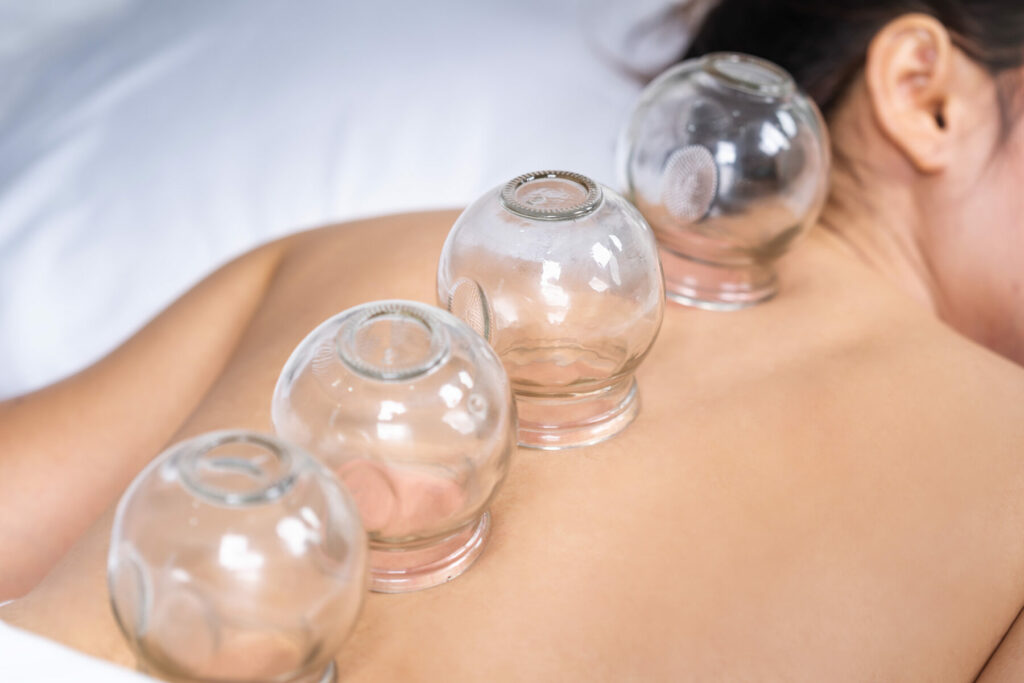 Cupping treatment in Camberley, Surrey